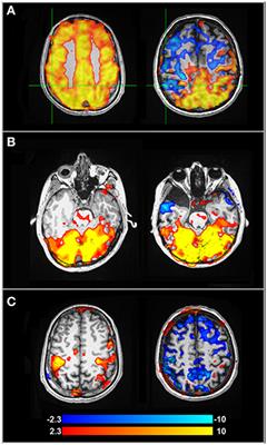 The Relationship Between Cognition and Cerebrovascular Reactivity: Implications for Task-Based fMRI